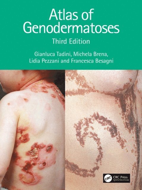 Lidia Pezzani, Francesca Besagni, Michela Brena, Gianluca Tadini - Atlas of Genodermatoses, E-bok