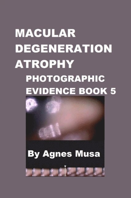 Macular Degeneration Atrophy, Photographic Evidence Book 5