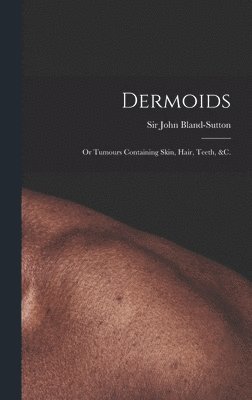 Dermoids