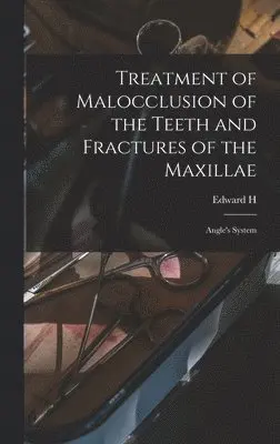 Edward H 1855-1930 Angle - Treatment of Malocclusion of the Teeth and Fractures of the Maxillae, Inbunden. Tillgänglighet: Lägg i varukorg