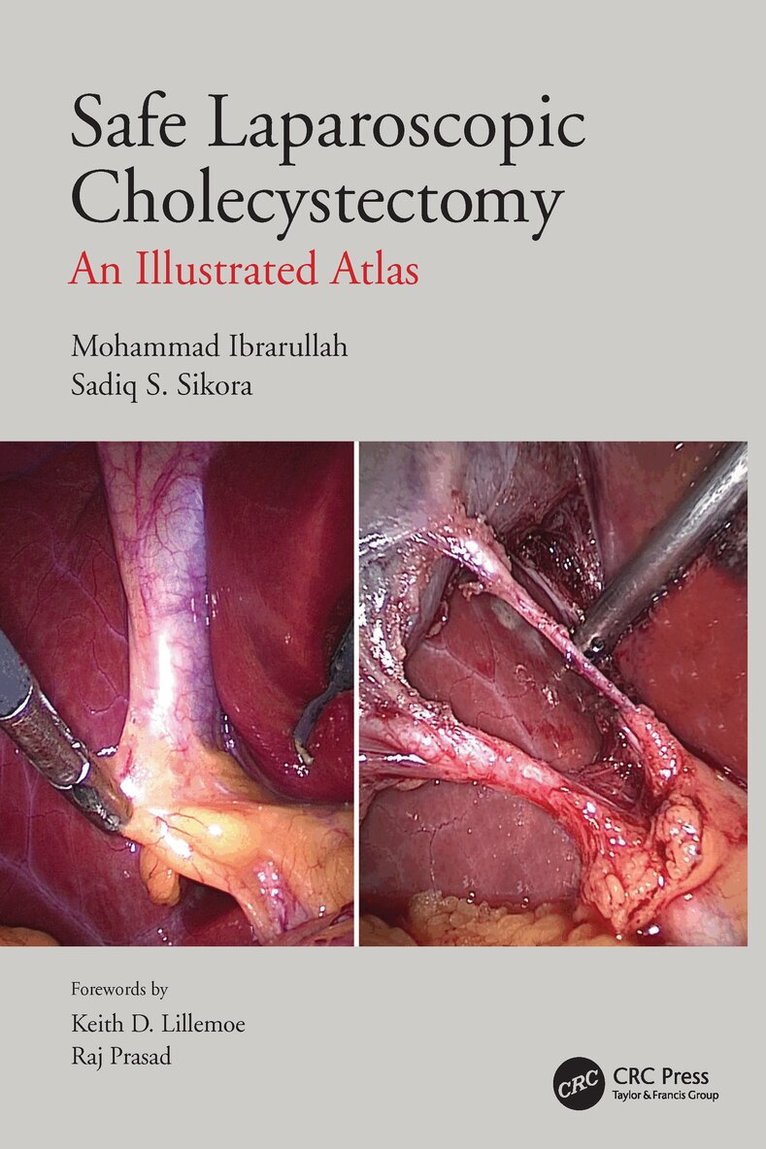 Mohammad Ibrarullah, Sadiq S Sikora - Safe Laparoscopic Cholecystectomy, Häftad