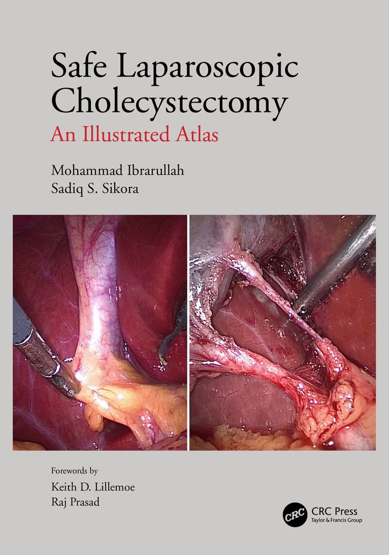 Mohammad Ibrarullah, Sadiq S Sikora - Safe Laparoscopic Cholecystectomy, Inbunden