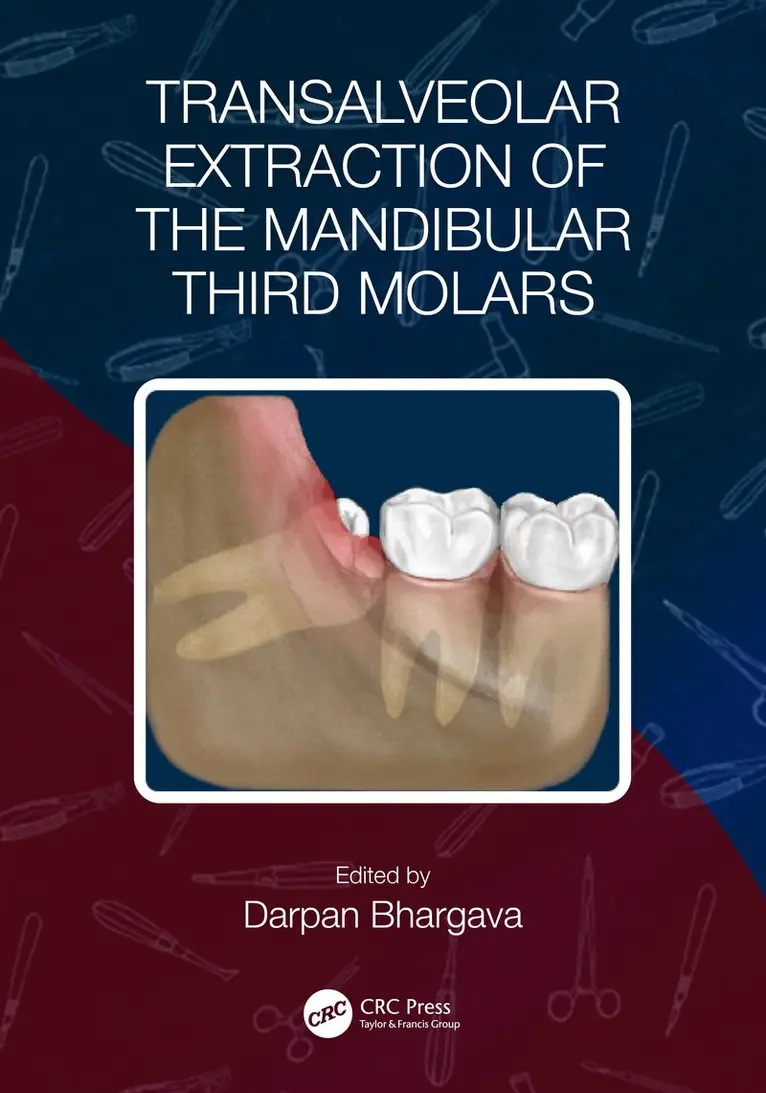 Darpan Bhargava - Transalveolar Extraction of the Mandibular Third Molars, Häftad. Tillgänglighet: Lägg i varukorg