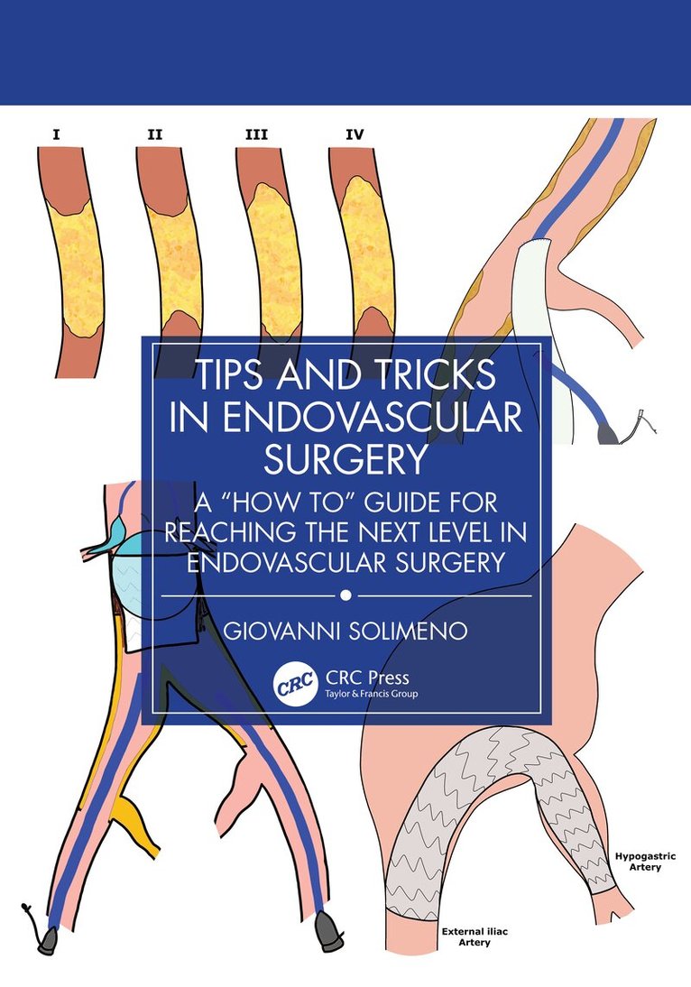 Giovanni Solimeno - Tips and Tricks in Endovascular Surgery, Häftad. Tillgänglighet: Lägg i varukorg