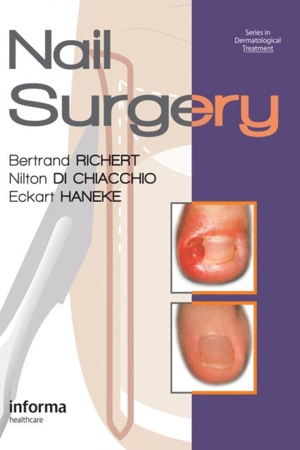 Eckart Haneke, Nilton Di Chiacchio, Bertrand Richert - Nail Surgery, E-bok