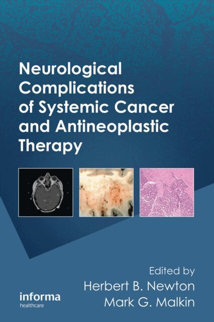 Mark G. Malkin, Herbert B. Newton - Neurological Complications of Systemic Cancer and Antineoplastic Therapy, E-bok