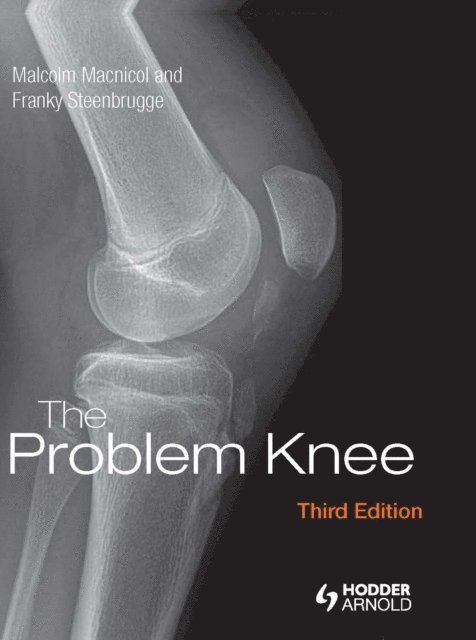 Franky Steenbrugge, Malcolm Macnicol - Problem Knee, E-bok. Tillgänglighet: Lägg i varukorg