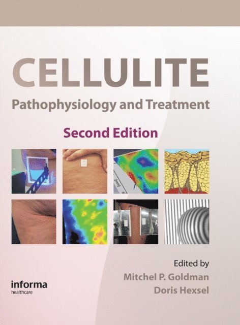 Doris Hexsel, Mitchel P. Goldman - Cellulite, E-bok