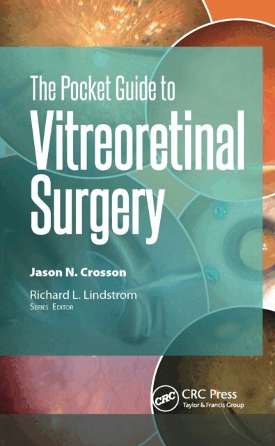 Pocket Guide to Vitreoretinal Surgery
