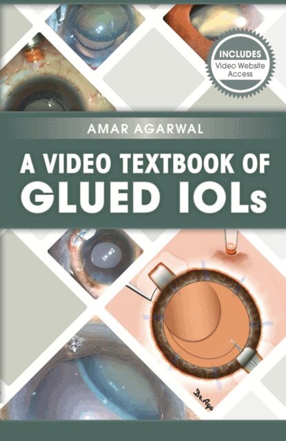 Amar Agarwal - Video Textbook of Glued IOLs, E-bok