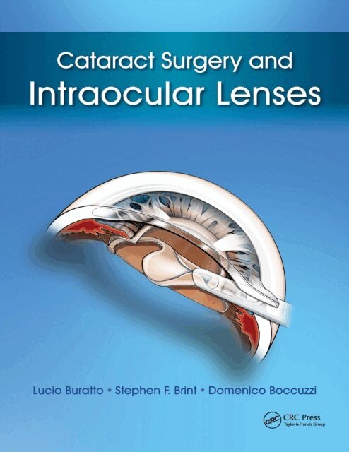 Domenico Boccuzzi, Stephen Brint, Lucio Buratto - Cataract Surgery and Intraocular Lenses, E-bok. Tillgänglighet: Lägg i varukorg