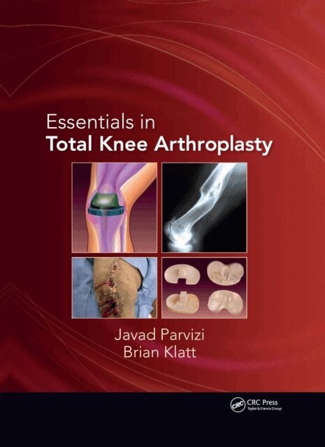 Brian Klatt, Javad Parvizi - Essentials in Total Knee Arthroplasty, E-bok. Tillgänglighet: Lägg i varukorg