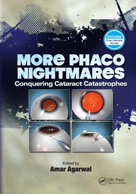 Amar Agarwal - More Phaco Nightmares, E-bok