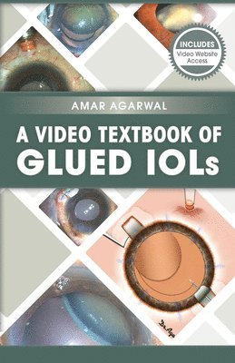 Amar Agarwal - Video Textbook of Glued IOLs, E-bok