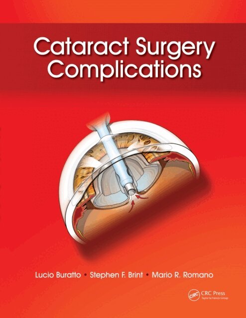 Mario Romano, Stephen Brint, Lucio Buratto - Cataract Surgery Complications, E-bok. Tillgänglighet: Lägg i varukorg