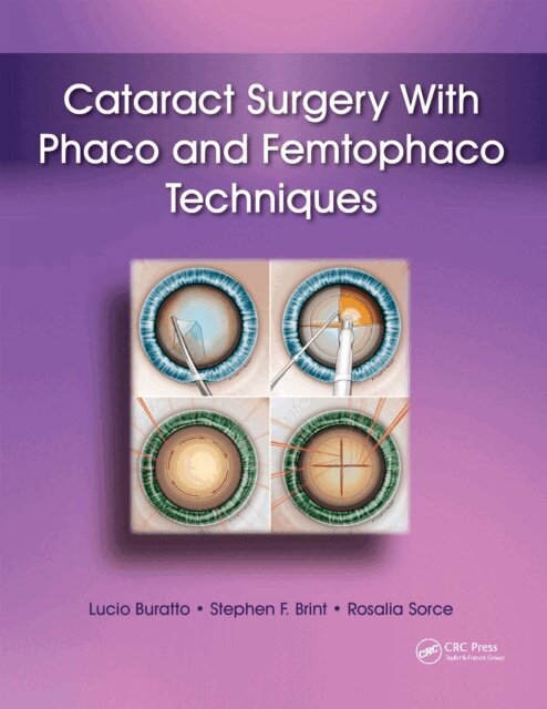 Rosalia Sorce, Stephen Brint, Lucio Buratto - Cataract Surgery With Phaco and Femtophaco Techniques, E-bok. Tillgänglighet: Lägg i varukorg