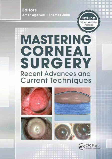 Thomas John, Amar Agarwal - Mastering Corneal Surgery, E-bok