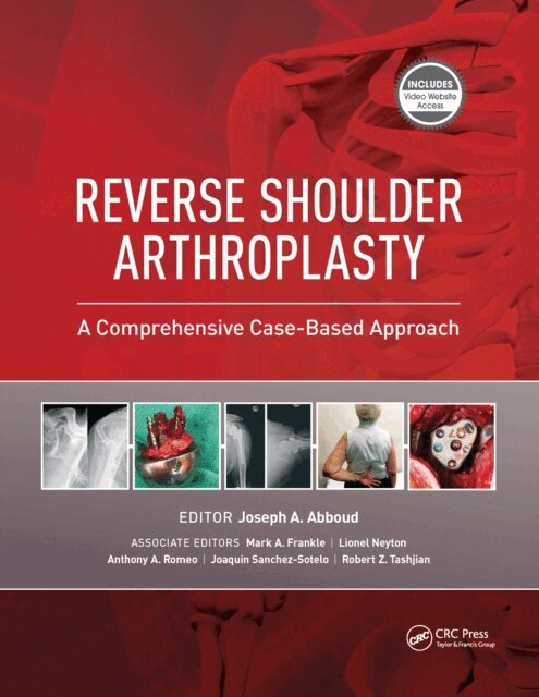 Joseph Abboud - Reverse Shoulder Arthroplasty, E-bok. Tillgänglighet: Lägg i varukorg