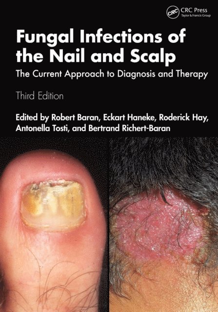 Bertrand Richert-Baran, Antonella Tosti, Roderick Hay, Eckart Haneke, Robert Baran - Fungal Infections of the Nail and Scalp, E-bok