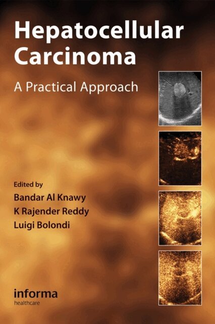 Luigi Bolondi, K. Rajender Reddy, Bandar Al Knawy - Hepatocellular Carcinoma, E-bok