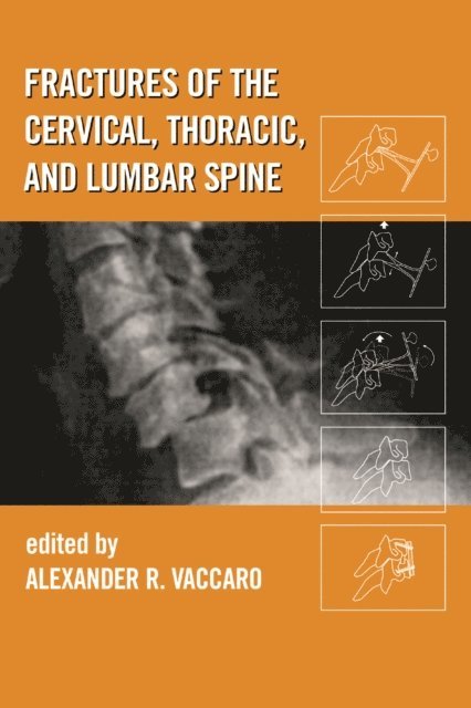 Alexander R. Vaccaro - Fractures of the Cervical, Thoracic, and Lumbar Spine, E-bok