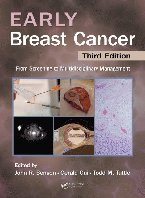 Todd Tuttle, Gerald P.H. Gui, John R Benson - Early Breast Cancer, E-bok