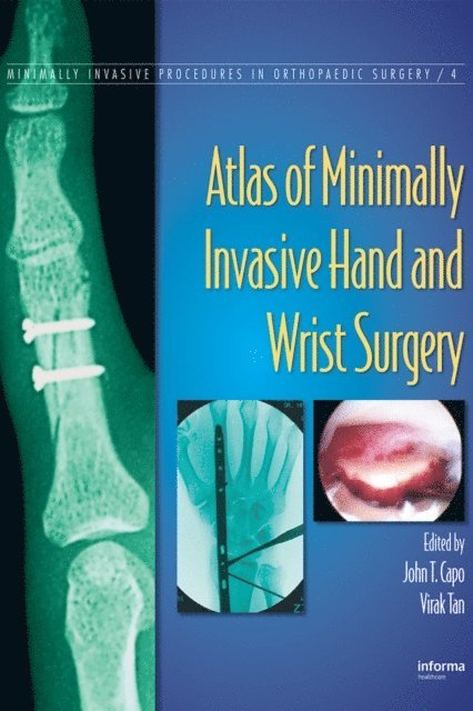 Virak Tan, John T. Capo - Atlas of Minimally Invasive Hand and Wrist Surgery, E-bok