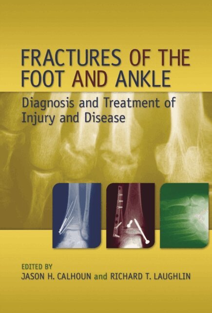 Richard T. Laughlin, Jason H. Calhoun - Fractures of the Foot and Ankle, E-bok
