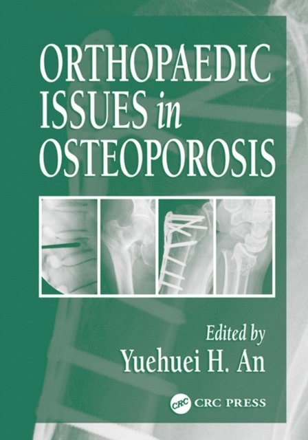 Yuehuei H. An - Orthopaedic Issues in Osteoporosis, E-bok. Tillgänglighet: Lägg i varukorg