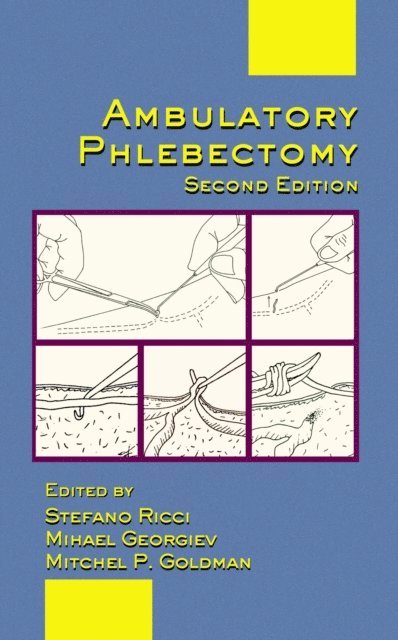 Stefano Ricci, Mihael Georgiev, Mitchel P. Goldman - Ambulatory Phlebectomy, E-bok