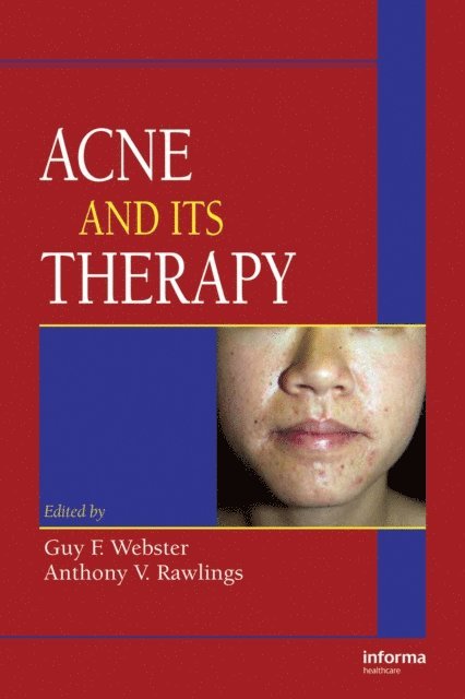Anthony V. Rawlings, Guy F. Webster - Acne and Its Therapy, E-bok