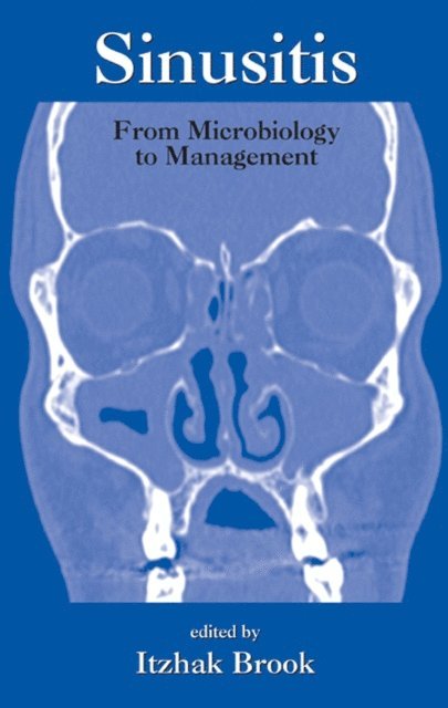 Itzhak Brook - Sinusitis, E-bok