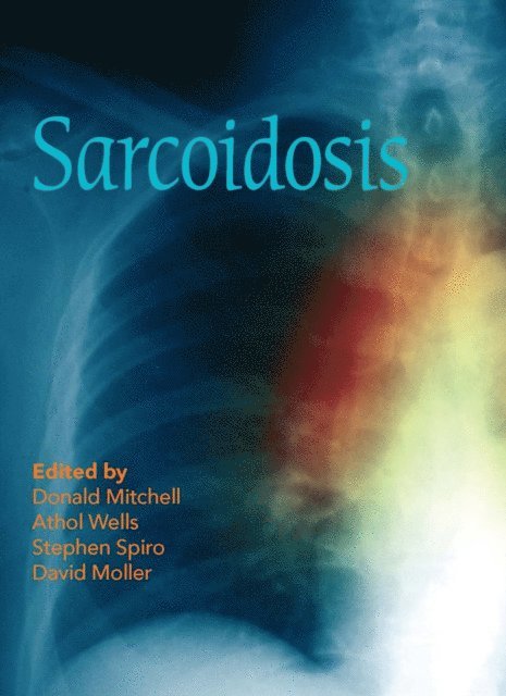 David Moller, Stephen Spiro, Athol Wells, Donald Mitchell - Sarcoidosis, E-bok