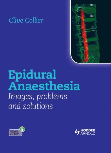 Clive Collier - Epidural Anaesthesia: Images, Problems and Solutions, E-bok