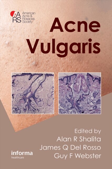 Guy Webster, James Q. Del Rosso, Alan R. Shalita - Acne Vulgaris, E-bok