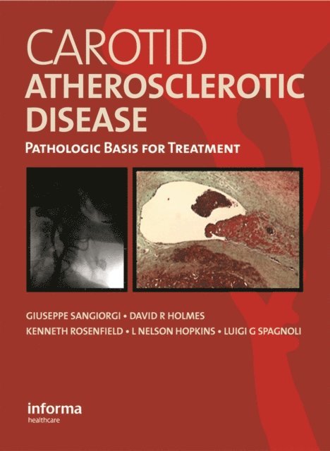 Luigi Spagnoli, L. Nelson Hopkins, Kenneth Rosenfield, David R. Holmes, Giuseppe Sangiorgi - Carotid Atherosclerotic Disease, E-bok