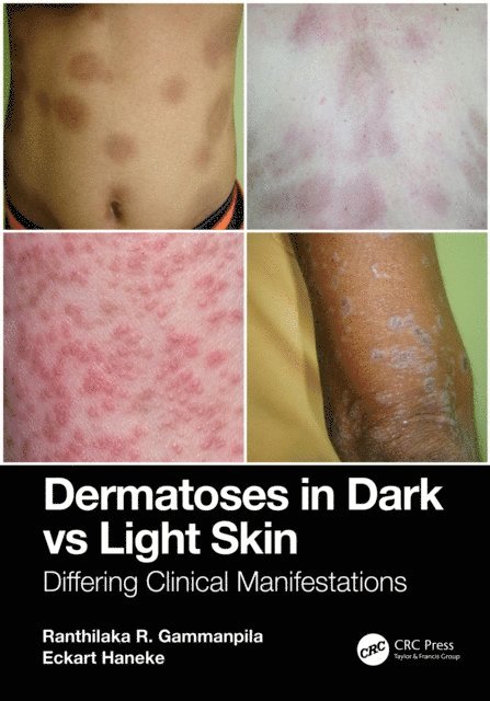 Eckart Haneke, Ranthilaka R. Gammanpila - Dermatoses in Dark Vs Light Skin, E-bok