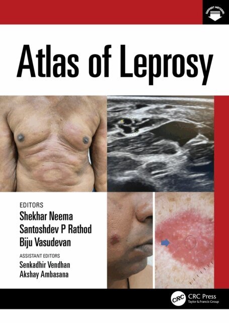 Biju Vasudevan, Santoshdev Rathod, Shekhar Neema - Atlas of Leprosy, E-bok