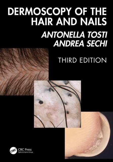 Andrea Sechi, Antonella Tosti - Dermoscopy of the Hair and Nails 3e, E-bok