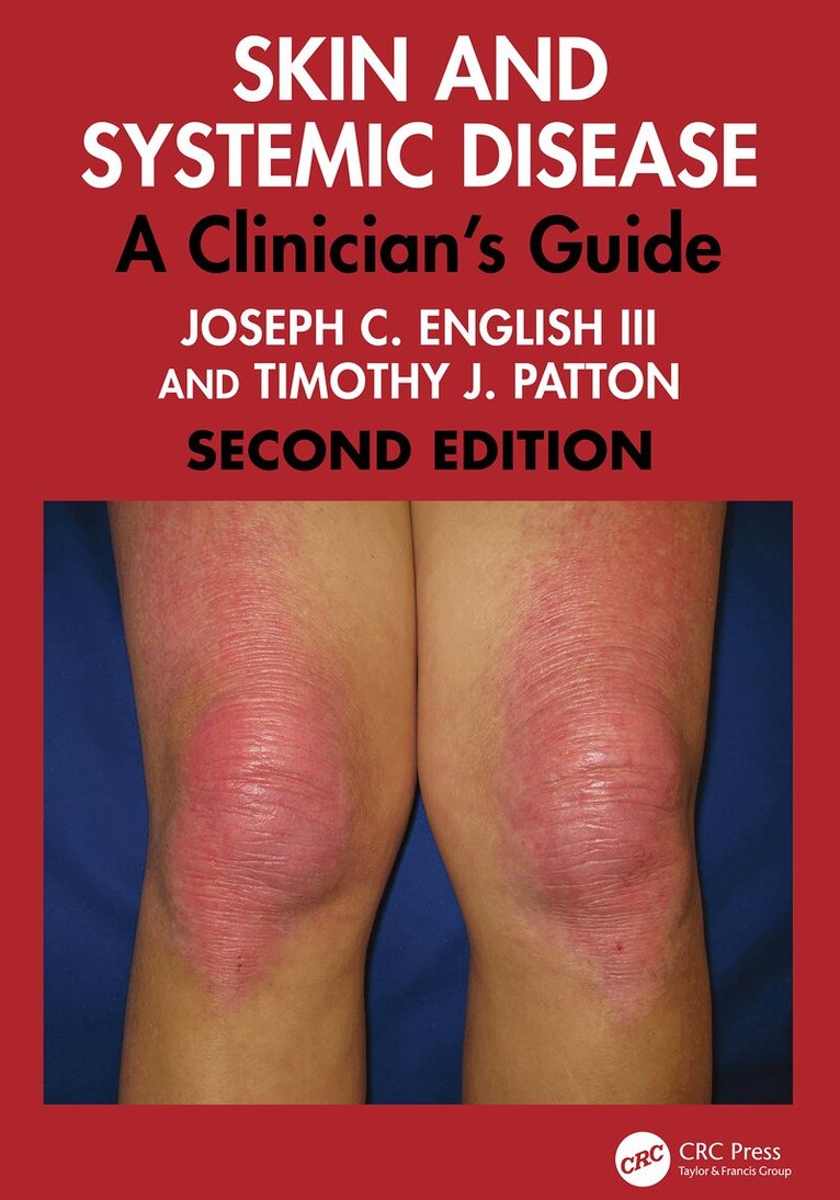 Joseph C. English III, Timothy J. Patton - Skin and Systemic Disease, E-bok