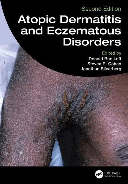 Jonathan Silverberg, Steven R. Cohen, Donald Rudikoff - Atopic Dermatitis and Eczematous Disorders, E-bok. Tillgänglighet: Lägg i varukorg
