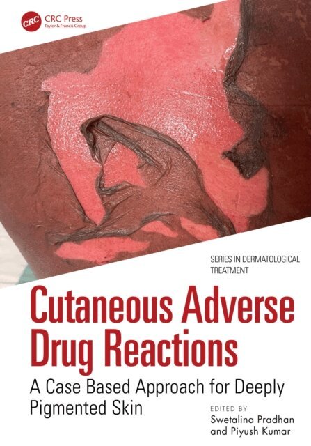 Piyush Kumar, Swetalina Pradhan - Cutaneous Adverse Drug Reactions, E-bok