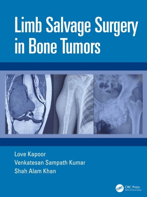 Shah Alam Khan, Venkatesan Sampath Kumar, Love Kapoor - Limb Salvage Surgery in Bone Tumors, E-bok. Tillgänglighet: Lägg i varukorg