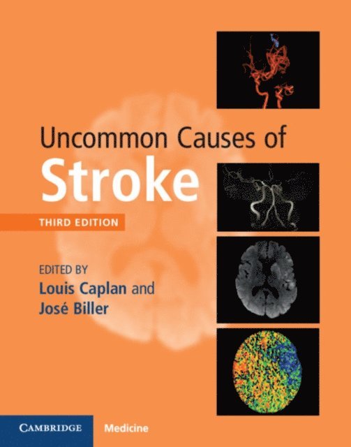 Jose Biller, Louis Caplan - Uncommon Causes of Stroke, E-bok