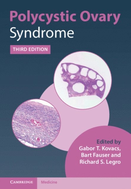 Richard S. Legro, Bart Fauser, Gabor T. Kovacs - Polycystic Ovary Syndrome, E-bok