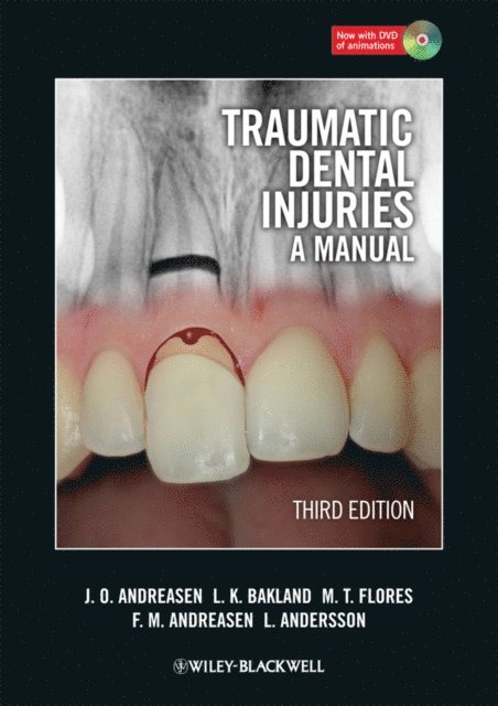Lars Andersson, Frances M. Andreasen, Maria Teresa Flores, Leif K. Bakland, Jens O. Andreasen - Traumatic Dental Injuries, E-bok