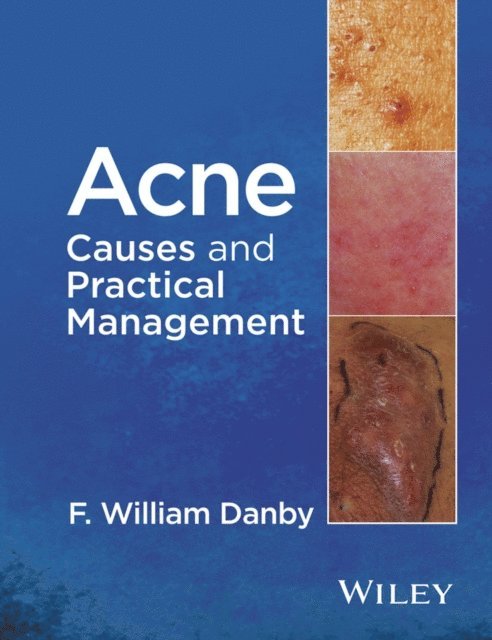 F. William Danby - Acne, E-bok. Tillgänglighet: Lägg i varukorg