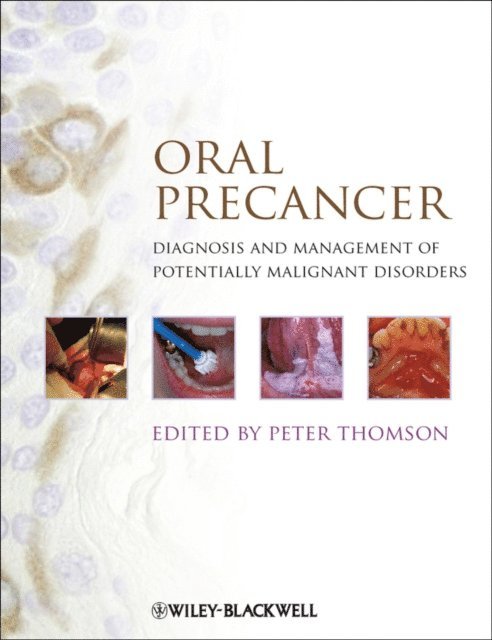 Peter Thomson - Oral Precancer, E-bok