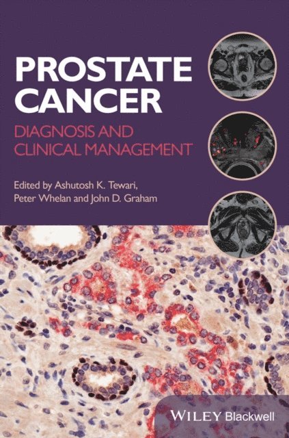 John D. Graham, Peter Whelan, Ashutosh K. Tewari - Prostate Cancer, E-bok