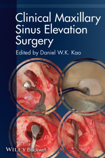 Daniel W. K. Kao - Clinical Maxillary Sinus Elevation Surgery, E-bok. Tillgänglighet: Lägg i varukorg